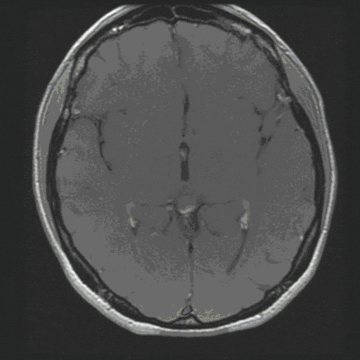 Akustikus-Neuronom Akustikus-Neuronom